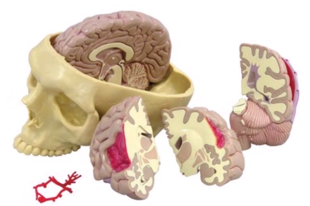 Model mózgu ze zmianami chorobowymi