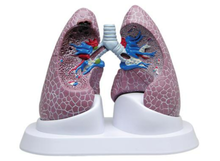 Model płuc ze zmianami patologicznymi